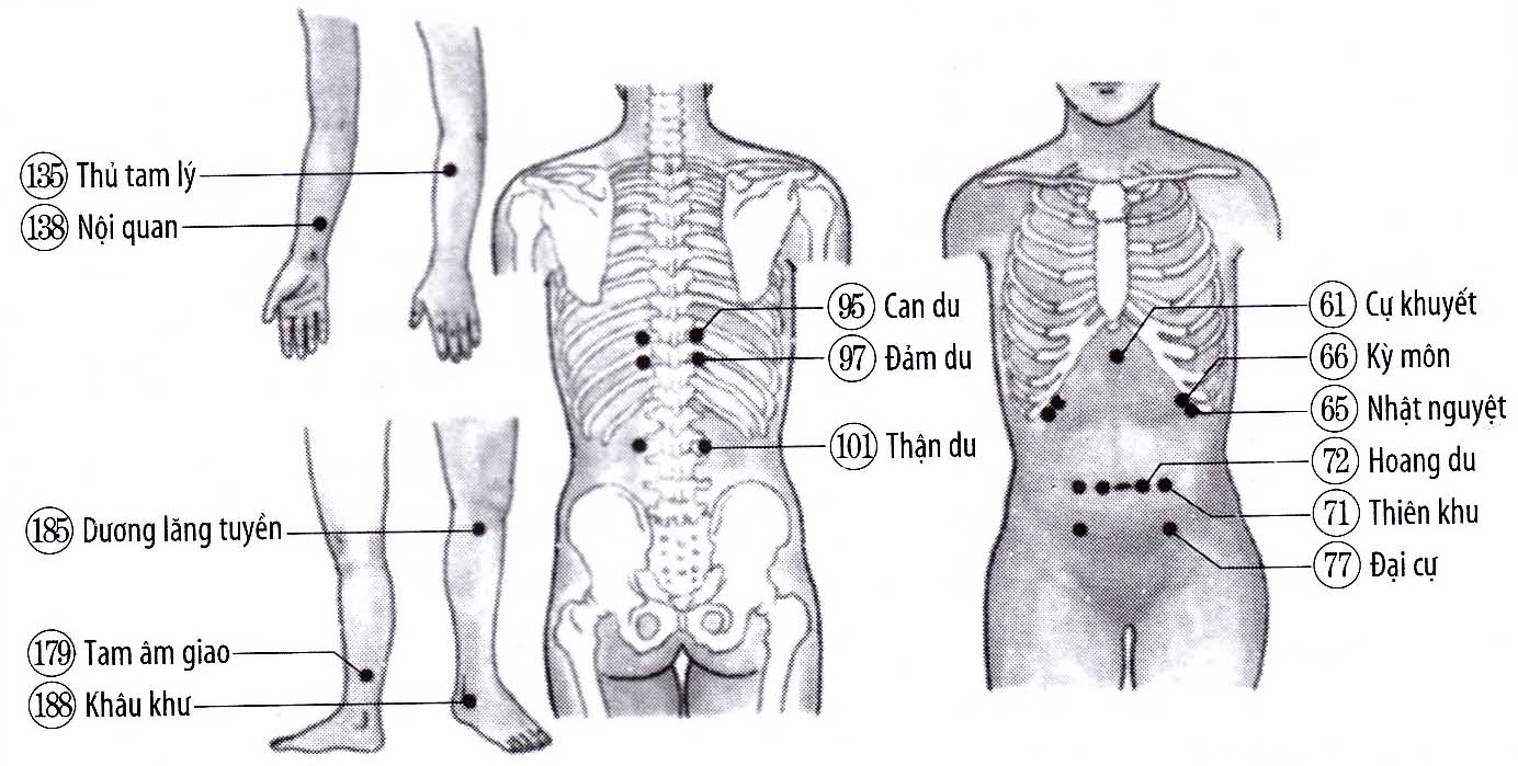 Sỏi mật, viêm túi mật