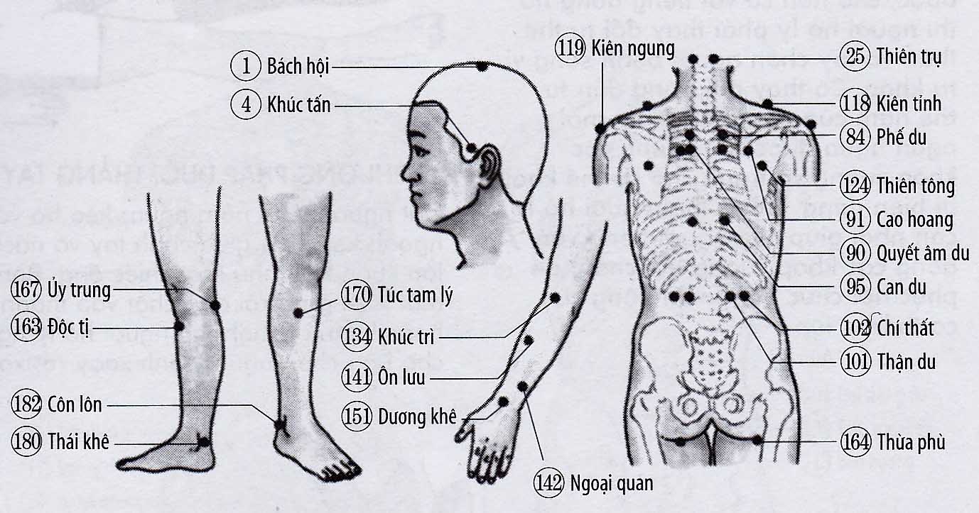 Bán thân bất toại (do trúng phong)