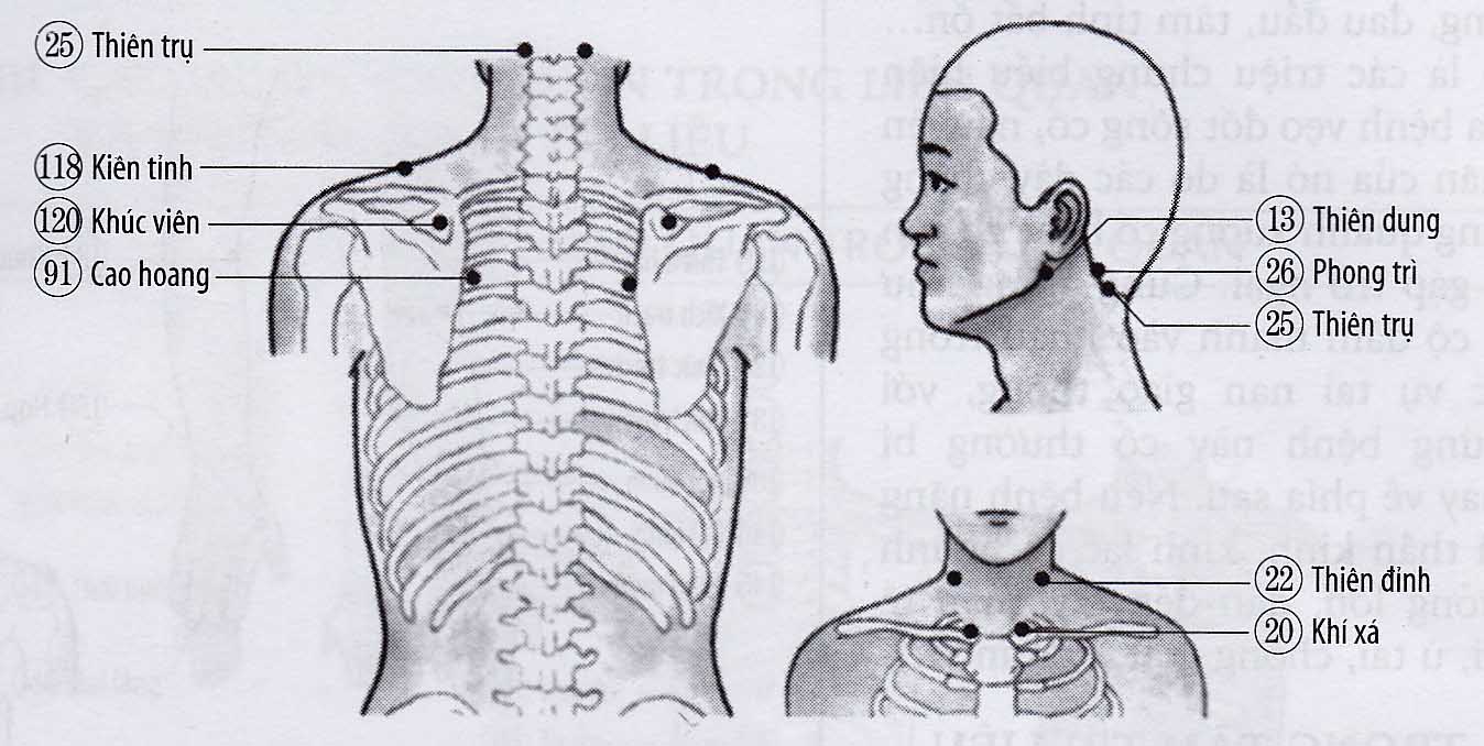 Vẹo cổ (lạc chẩm)