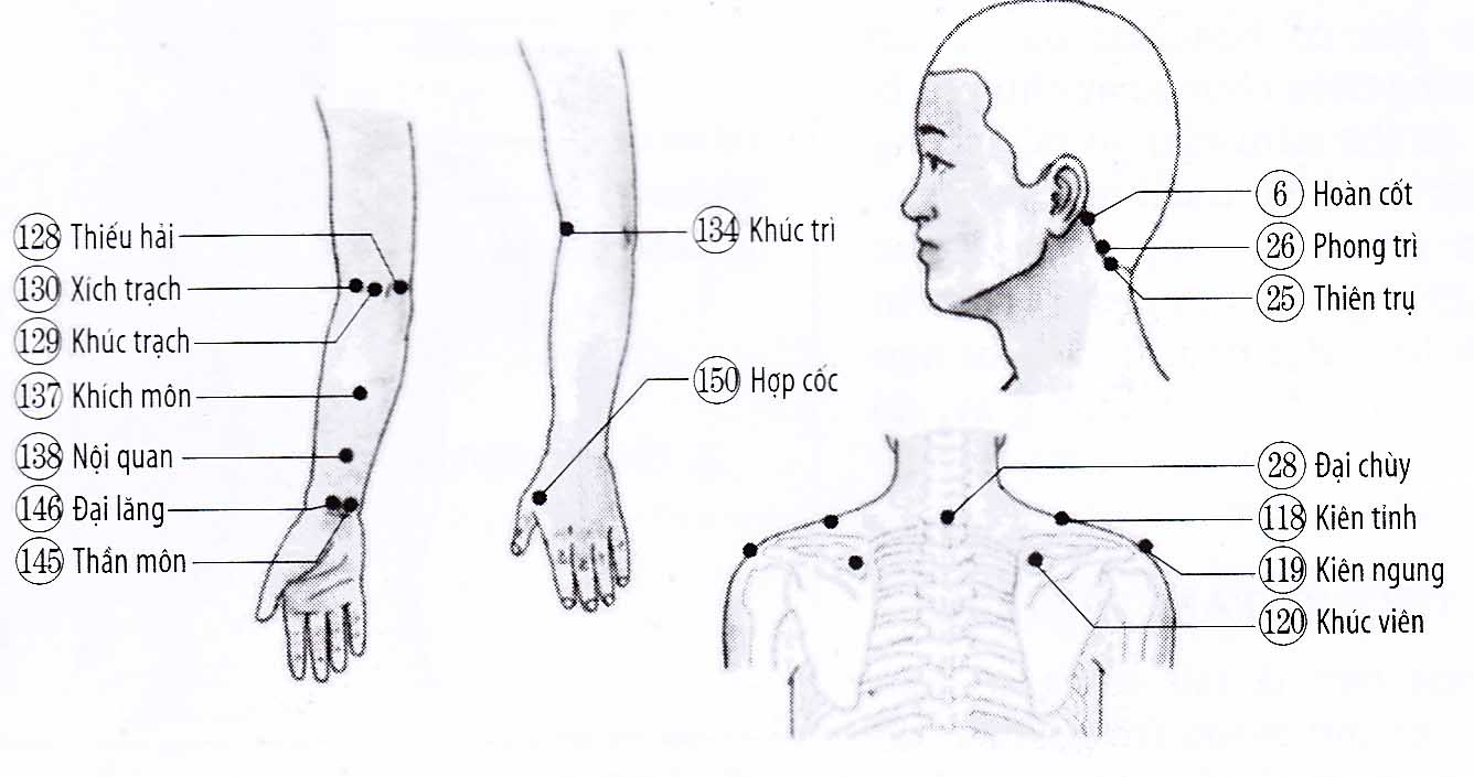Chứng vẹo đốt sống cổ